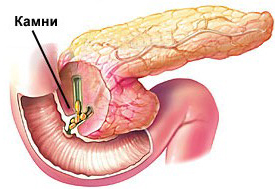 панкреатит